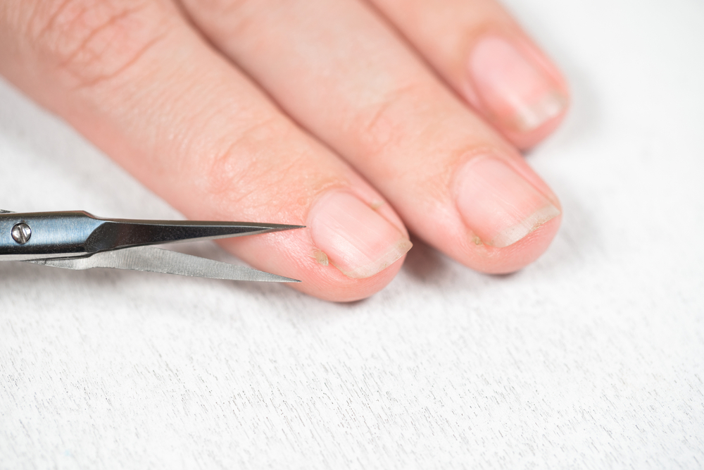 怎麼預防懸甲、指甲倒刺