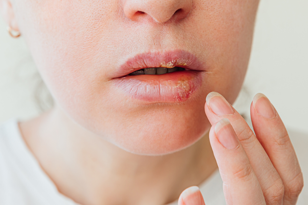唇皰疹 結痂是患有唇皰疹病毒的復原過程