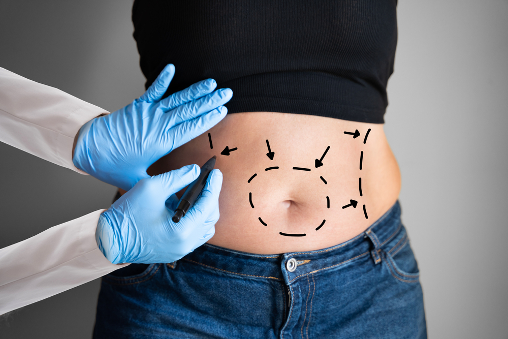 Abdominoplasty,Obesity,Surgery