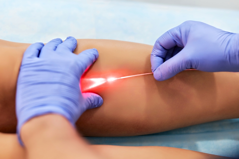 Varicose,Laser,Treatment,On,Female,Legs,In,Clinic