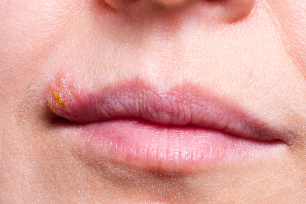 Herpes,On,The,Lip,Close,Up,Macro
